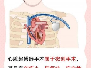 心脏起搏器：必要性及其影响，深入理解现代医疗科技的抉择之考量