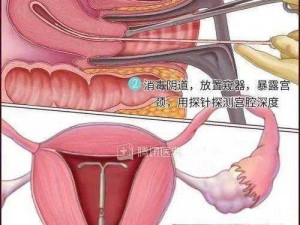 tubectomy相关产品介绍：女性长效可逆避孕方法——输卵管结扎术