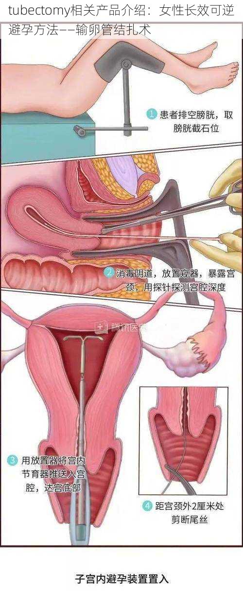 tubectomy相关产品介绍：女性长效可逆避孕方法——输卵管结扎术